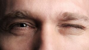 Blepharospasm