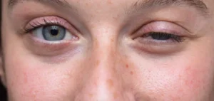 Myasthenia Gravis