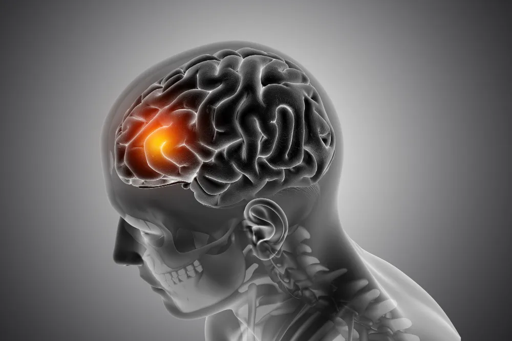 Brain seizure diagnosis and Epilepsy Treatment in Kanpur